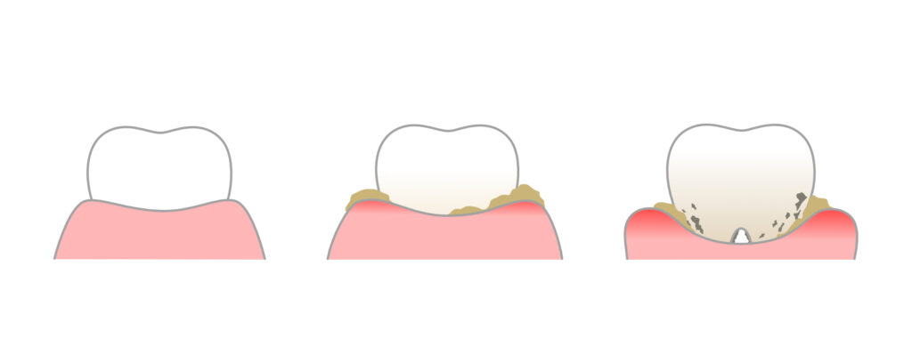 歯周病の軽度から重度までの進行を図で示した画像