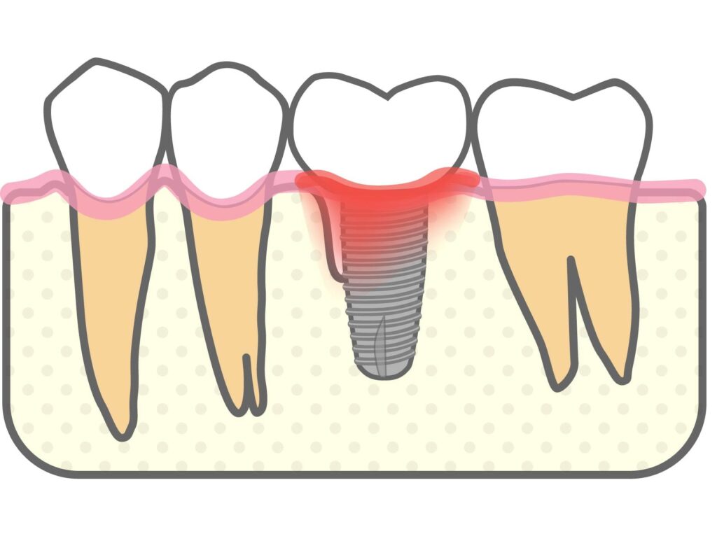 インプラント周囲炎の発生を説明するイラスト