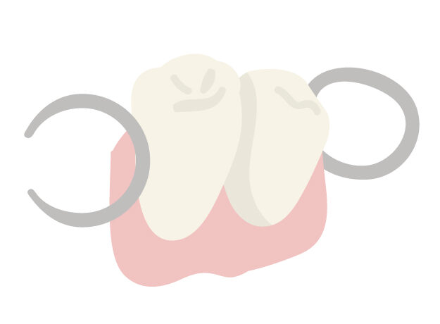 取り外し式の入れ歯の例を示す写真