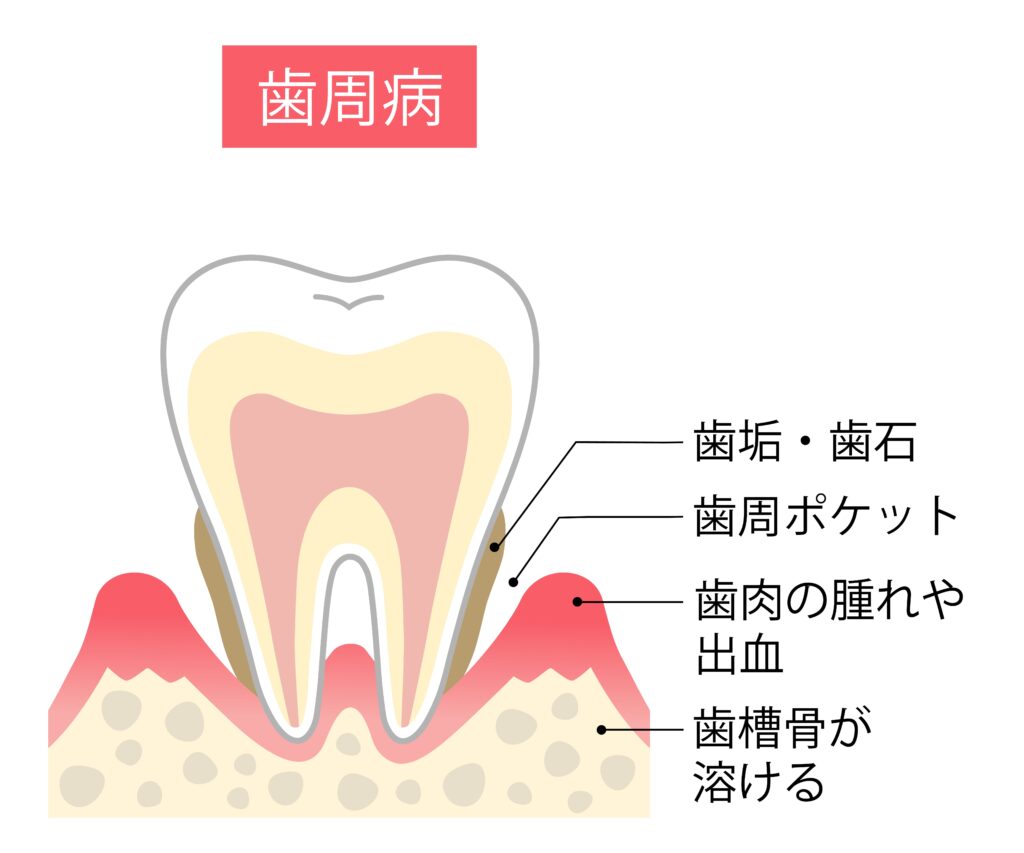歯周病の進行や歯ぐきの炎症を示すイラスト