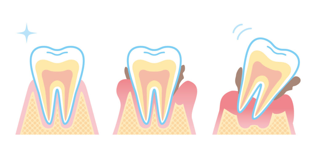 歯周病が進行する過程をわかりやすく示したイラスト