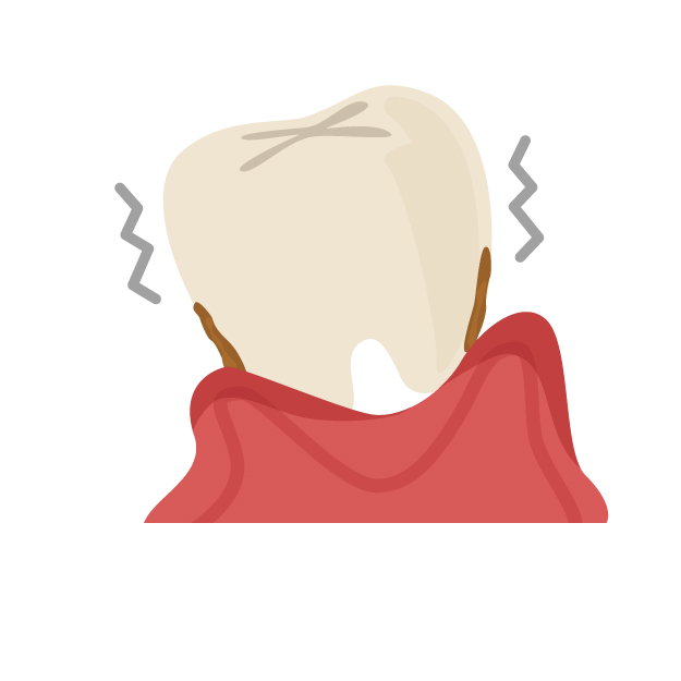 歯茎が下がり歯がぐらついている状態を示したイラスト