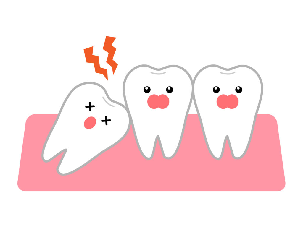斜めに生えて歯茎の中に埋まった親知らずと、その周囲に痛みがあることを示すイラスト