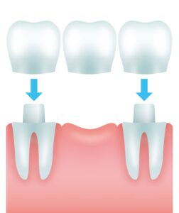 歯を補うためのブリッジ治療の例を示す画像