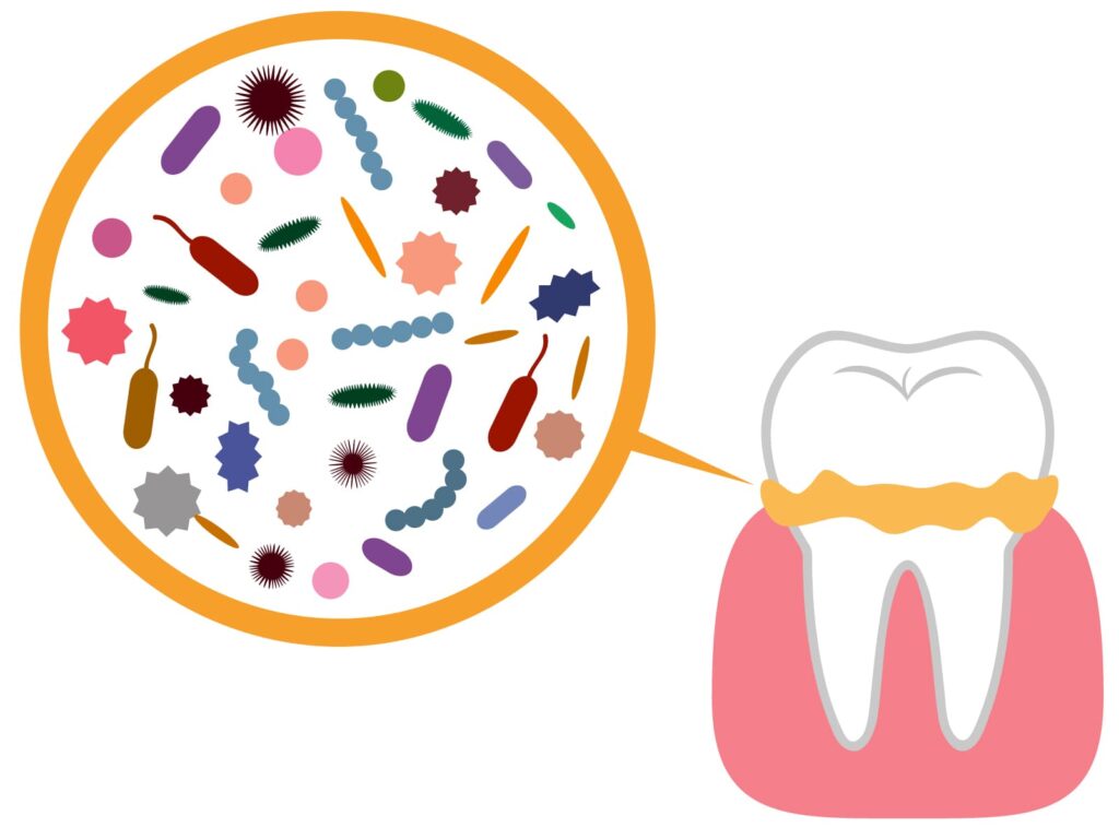 歯周病によって汚れがたまりやすい状態を示す図