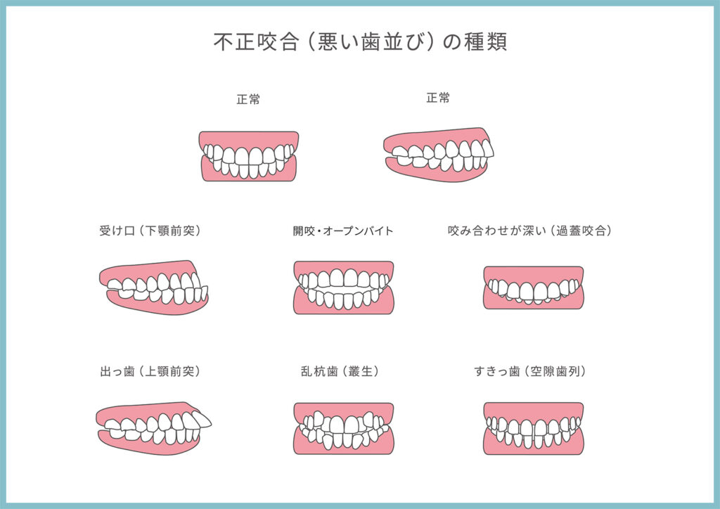 ほうれい線が目立ちやすくなる歯並びの種類を示したイラスト