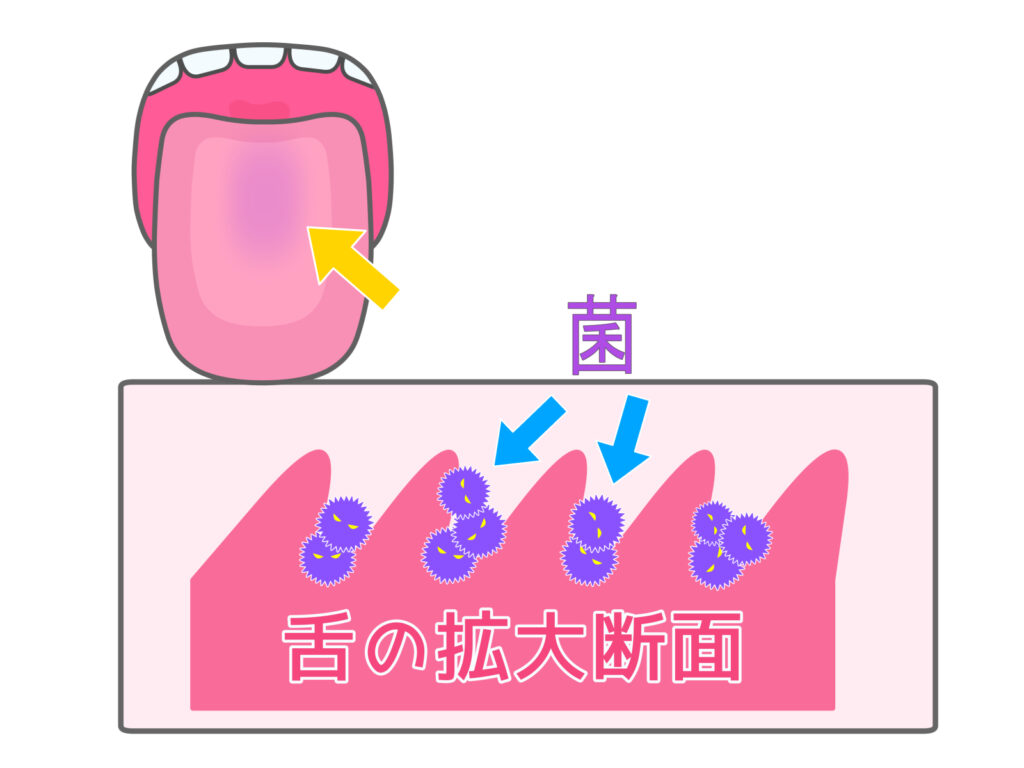 舌苔が付着した舌のイメージイラスト