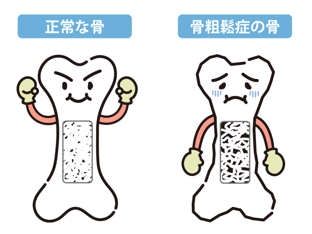 正常な骨と骨粗しょう症の骨を比較したイラスト