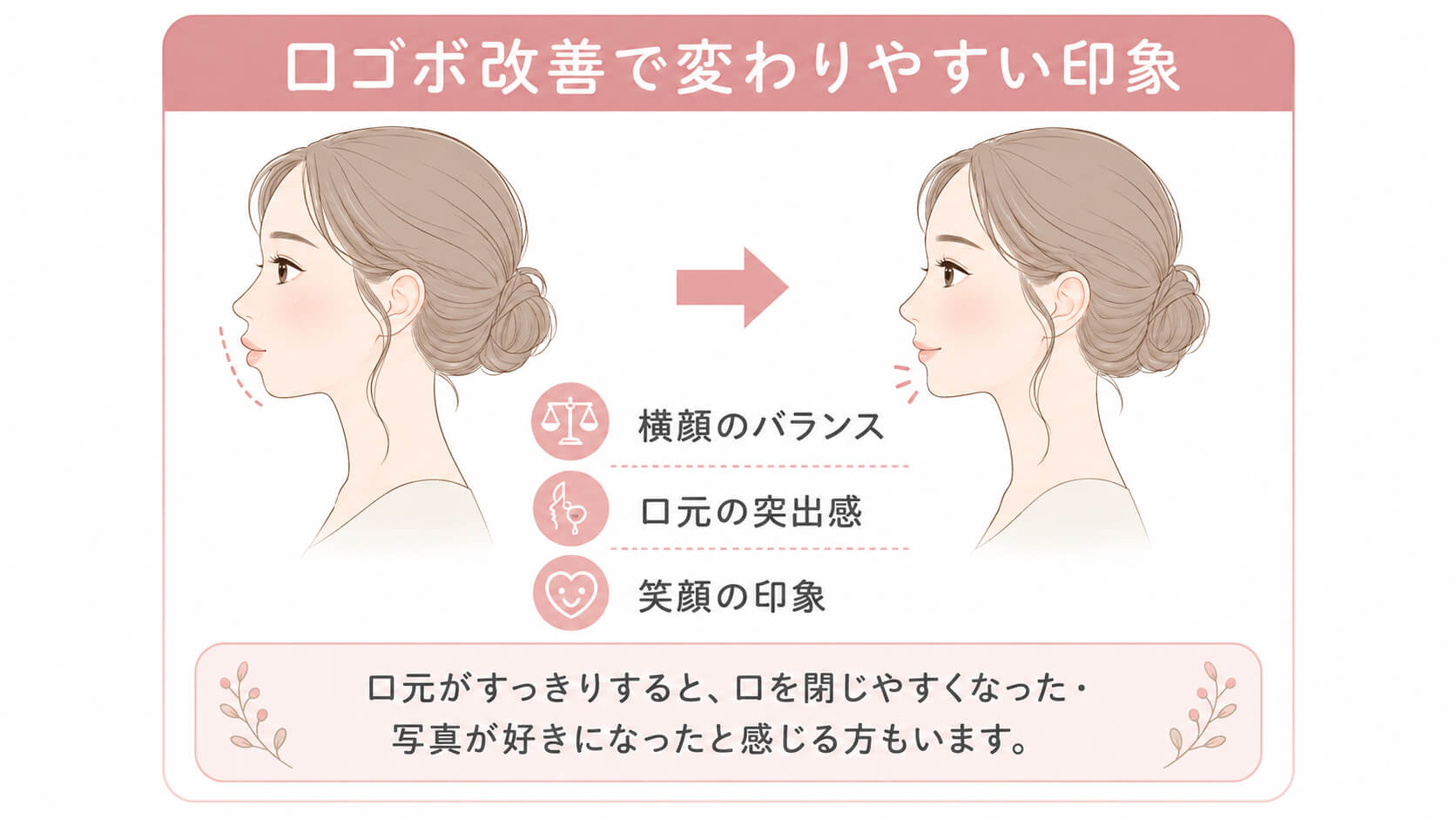 口ゴボ改善で変わりやすい横顔や笑顔の印象を示した図解