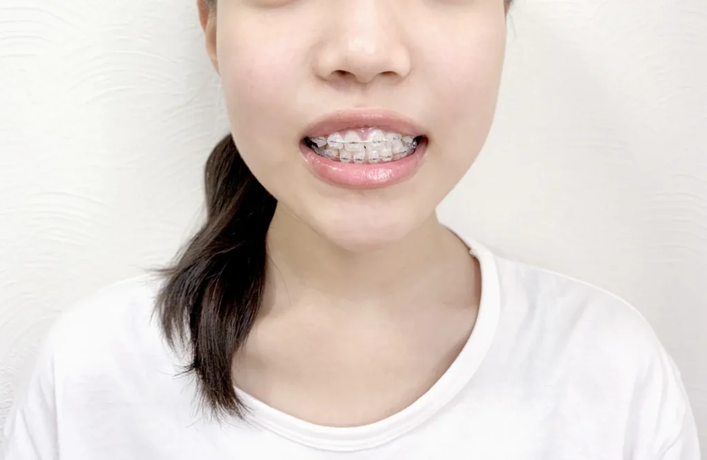 ワイヤー矯正中の女性の口元｜非抜歯矯正と出っ歯
