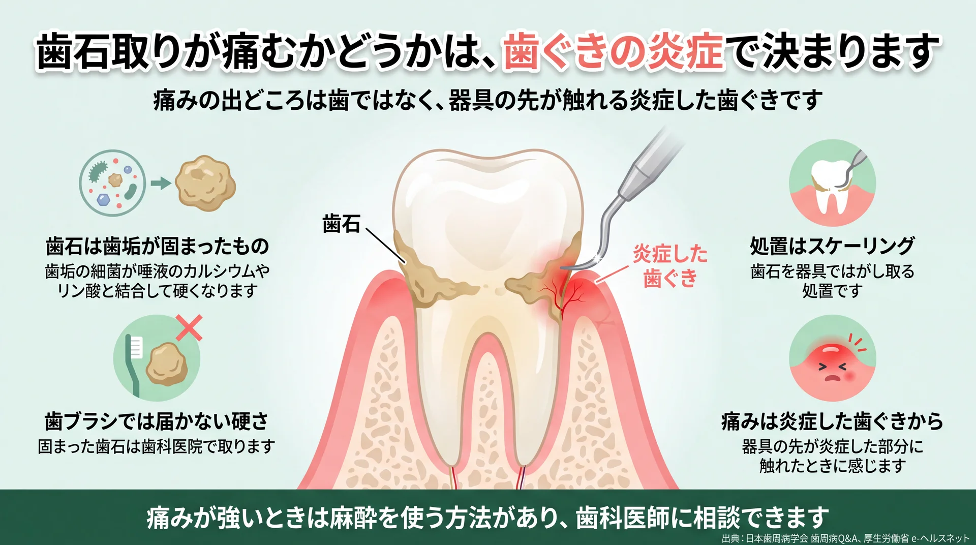 歯石の成り立ちと、スケーリングで痛みが出る部位が炎症した歯ぐきであることを示した断面図