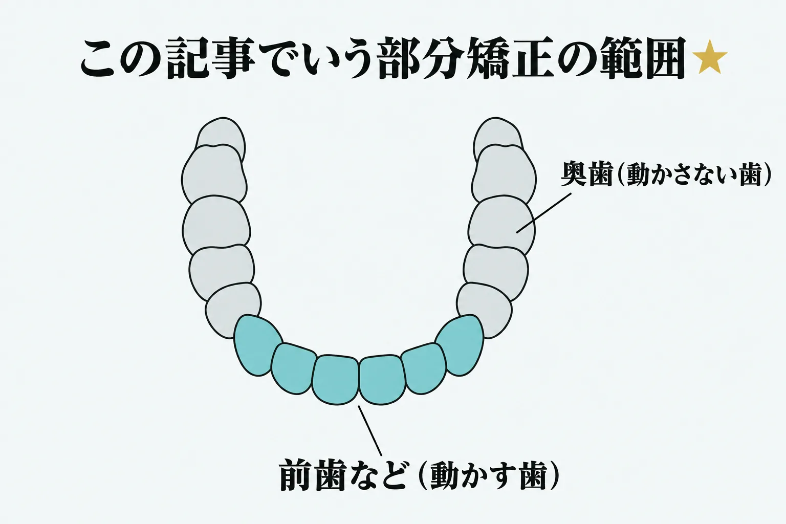 上の歯並びを上から見た模式図。前歯を色付きで、奥歯をグレーで示し、動かす範囲と動かさない範囲を分けている